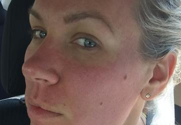 best sunscreen for face after laser treatment